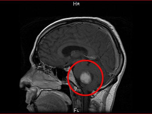 Exames mostraram um tumor do tamanho de uma bola de golfe no cérebro de Wheatley