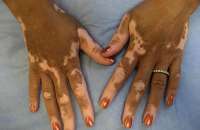 Mãos de paciente com vitiligo, que apresentam manchas brancas